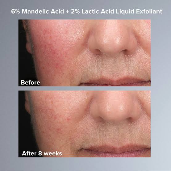 Skin Perfecting 6% Mandelic Acid + 2% Lactic Acid Liquid Exfoliant