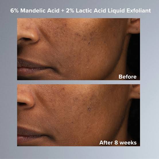 Skin Perfecting 6% Mandelic Acid + 2% Lactic Acid Liquid Exfoliant